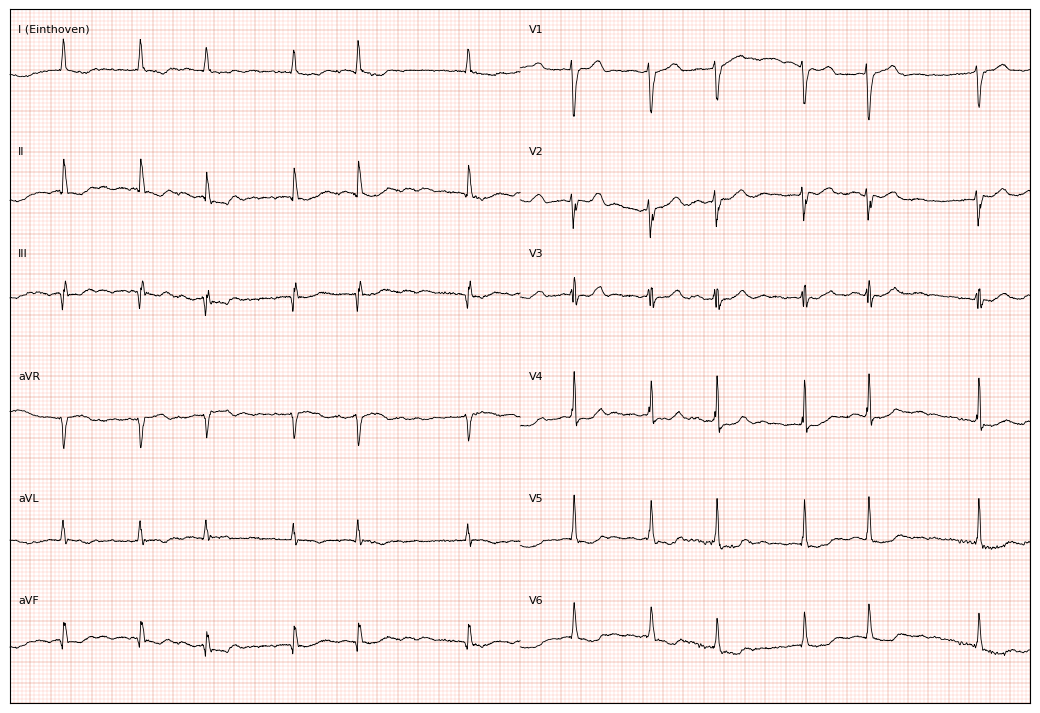 ../../_images/examples_recipe_plot_ecgs_3_0.png