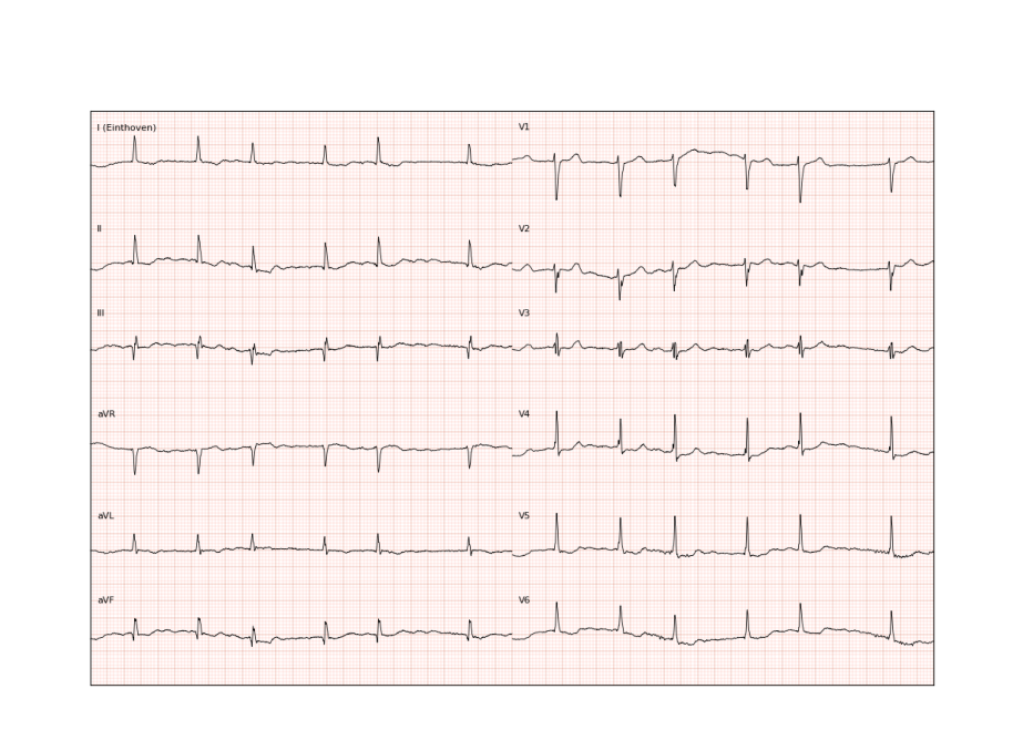 ../../_images/examples_recipe_plot_ecgs_6_0.png