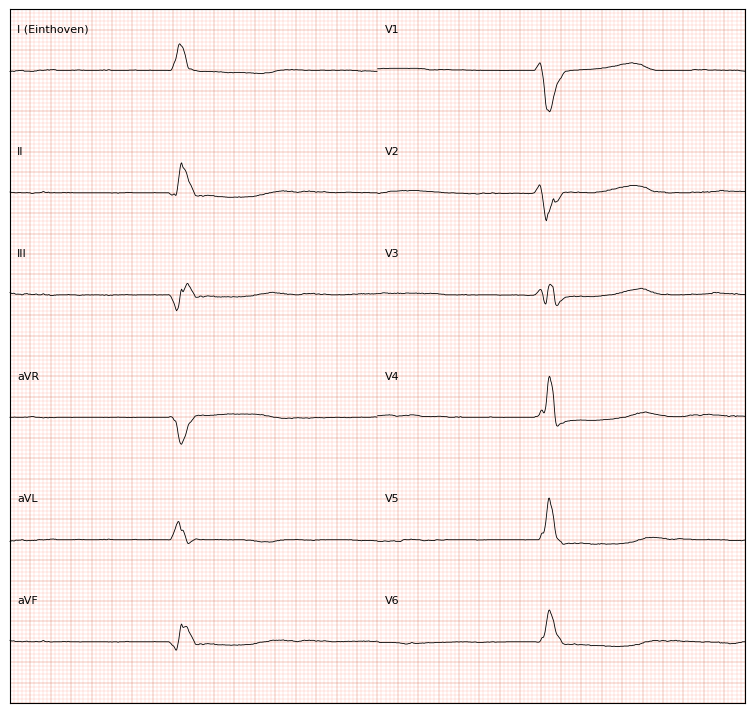 ../../_images/examples_recipe_plot_ecgs_8_0.png
